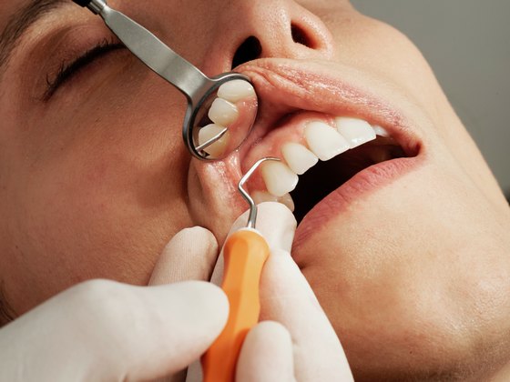 Fractura dentara: tipuri de fracturi, simptome si tratamente