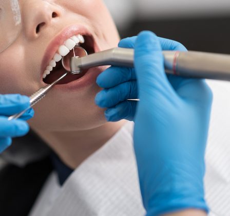 De ce sunt cariile dentare molipsitoare?